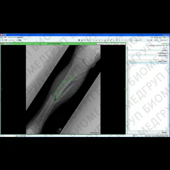 Модуль программного обеспечения для управления Fracture Management