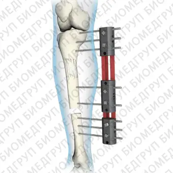 Внешний фиксатор большеберцовая кость Cromus