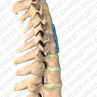 Шейная костная пластина для артродеза  Aditus T6Al4V ELI