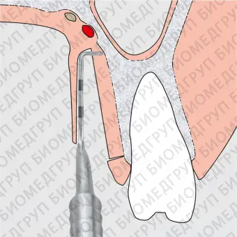 Двойной стоматологический бистури PALATAL