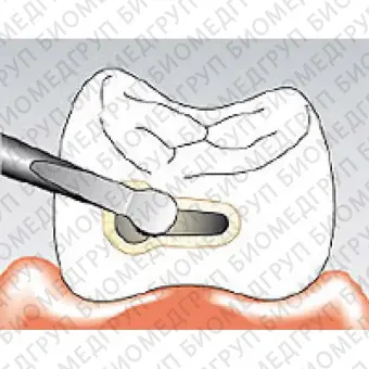 Sonicflex bevel 58 насадка для минимально инвазивной терапии кариеса с алмазным покрытием, мезиальная