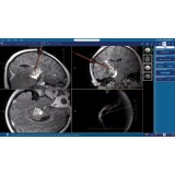 Программное обеспечение для медицинских снимков NeuroBlate ® SoftwareTM NeuroBlate ®